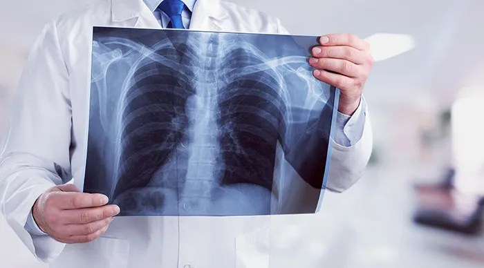 radiografie pulmonară
