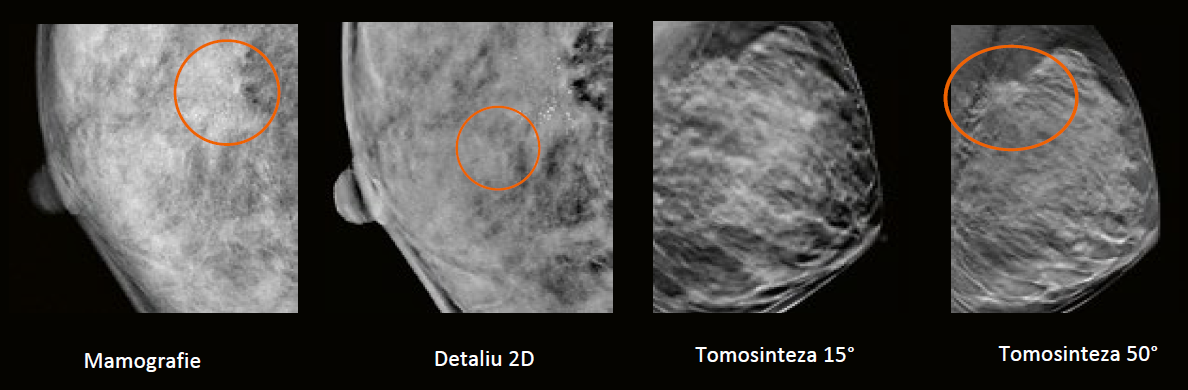 mamografie cu tomosinteză